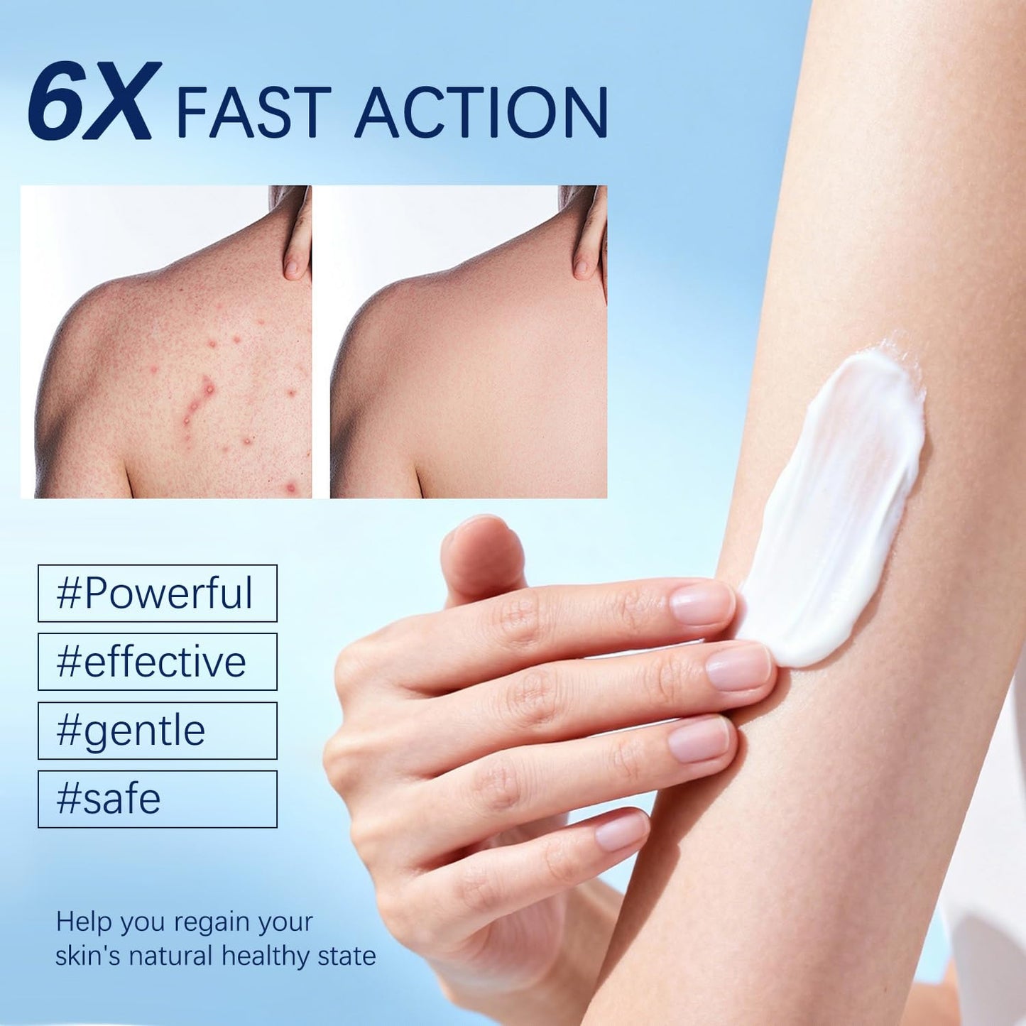 Folliculitis Cream | Soothes & Helps Clear Bumps on Scalp, Face, Body & Butt | for Ingrown Hairs, Razor Bumps & Acne | 120g (01)