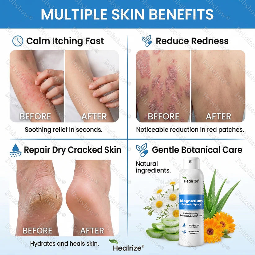 🔥Nreoeo® Magnesium Botanic Spray – Advanced Skin Recovery for Psoriasis & Eczema | Rapid Soothing, Steroid-Free