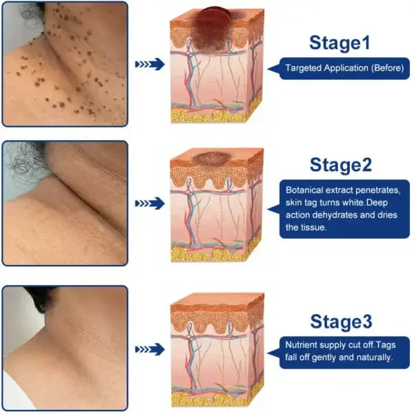 ✨😍Nreoeo® Targeted Skin Tag & Wart Removal Cream – Time-Released Phyto-Exfoliant (12% Celandine ) & Bio-Active Terpene Viral-Inhibitor (8% Thuja)