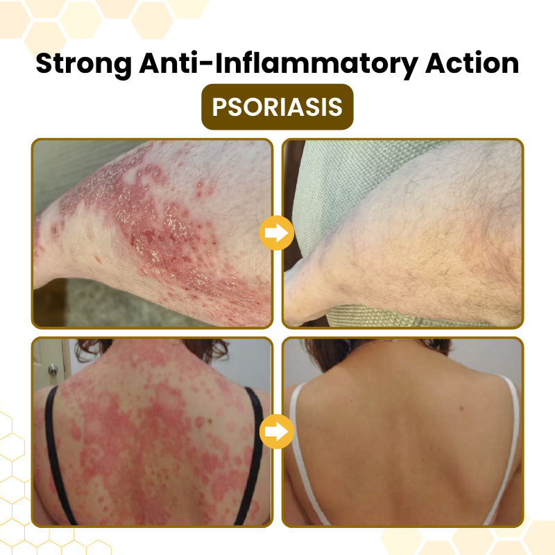 Nreoeo® PsoriaSoothe Skin Care Cream