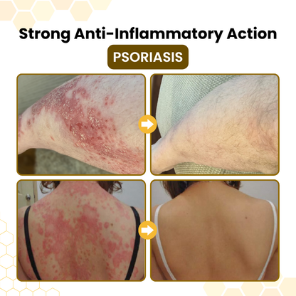 Nreoeo® PsoriaSoothe Skin Care Cream