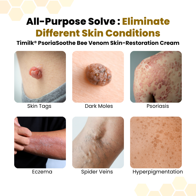 Nreoeo® PsoriaSoothe Skin Care Cream