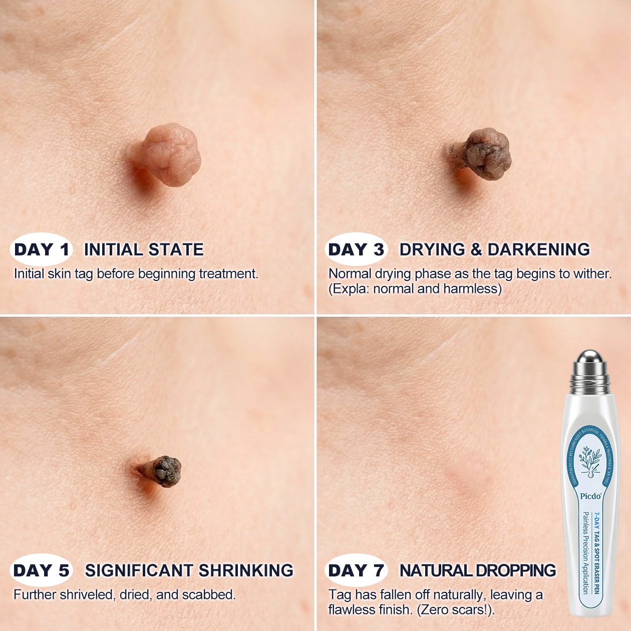 𝐎𝐟𝐟𝐢𝐜𝐢𝐚𝐥 𝐁𝐫𝐚𝐧𝐝 𝐒𝐭𝐨𝐫𝐞 |🧿Nreoeo® 7-𝐷𝑎𝑦 𝗧𝐚𝐠 & 𝗦𝗽𝐨𝐭 𝐄𝐫𝒂𝒔𝒆𝒓(Zero Pain, Zero 𝐒𝐜𝐚𝒓𝒔 Rollerball)💦