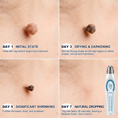 𝐎𝐟𝐟𝐢𝐜𝐢𝐚𝐥 𝐁𝐫𝐚𝐧𝐝 𝐒𝐭𝐨𝐫𝐞 |🧿Nreoeo® 7-𝐷𝑎𝑦 𝗧𝐚𝐠 & 𝗦𝗽𝐨𝐭 𝐄𝐫𝒂𝒔𝒆𝒓(Zero Pain, Zero 𝐒𝐜𝐚𝒓𝒔 Rollerball)💦